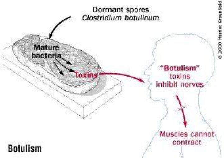 Can botulism go away on its own?