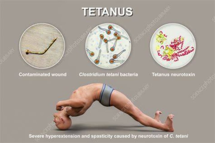 Can every cut cause tetanus?