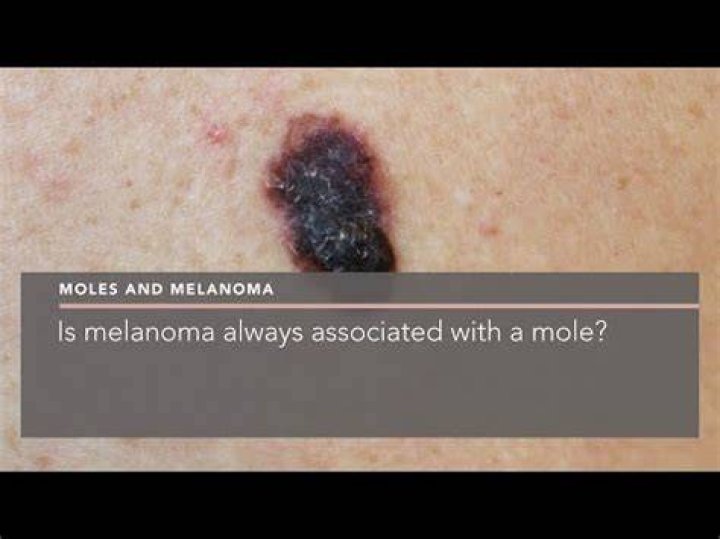 Can you have melanoma without a mole?