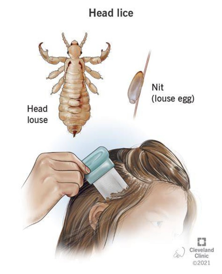 Do lice go inside your ears?