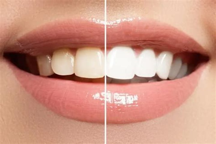 How can I whiten my teeth in 2 weeks?