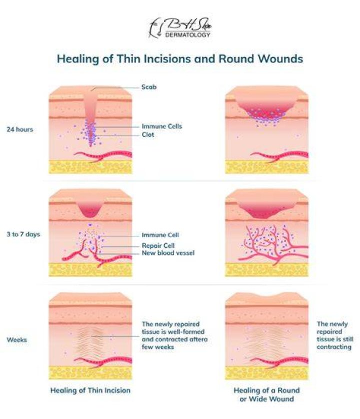 How do you soften surgical incisions?