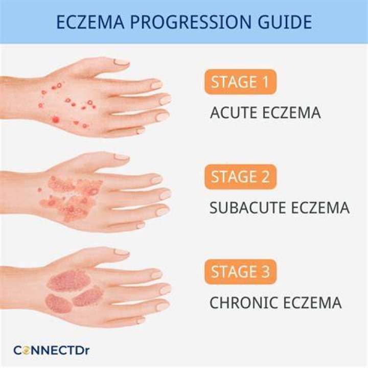 How long does eczema take to heal?