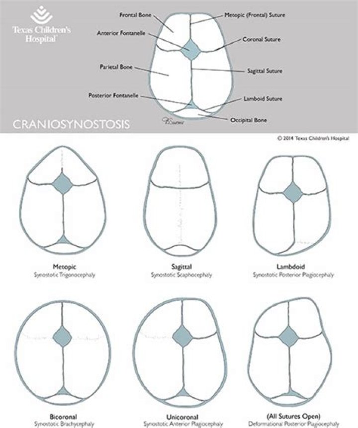 Is craniosynostosis painful?