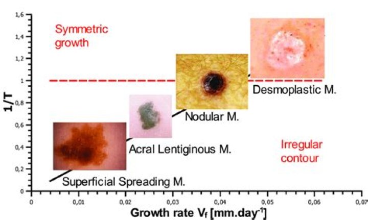 Is melanoma slow growing?