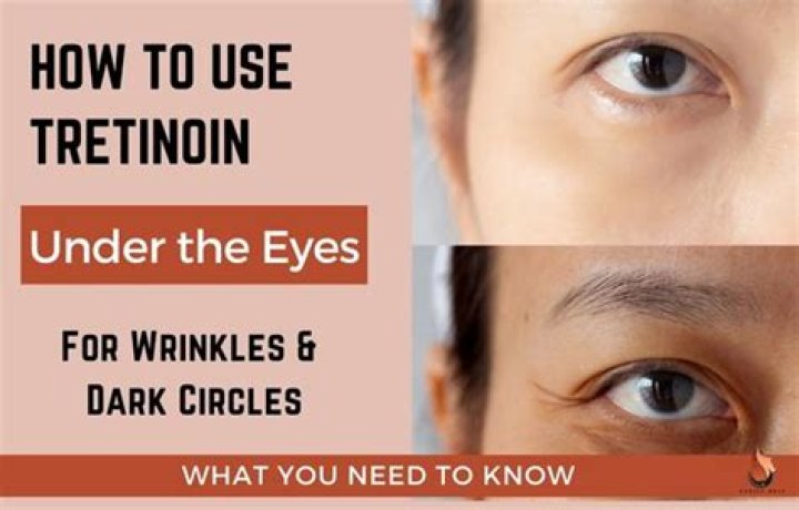 Is tretinoin good for dark circles?