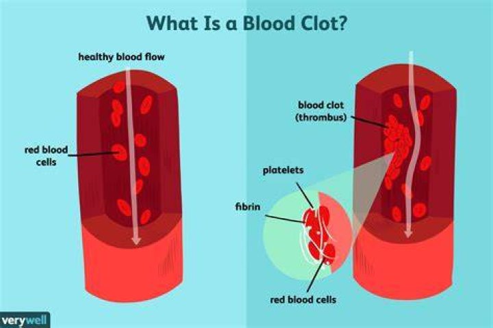 What cancers cause blood clots?