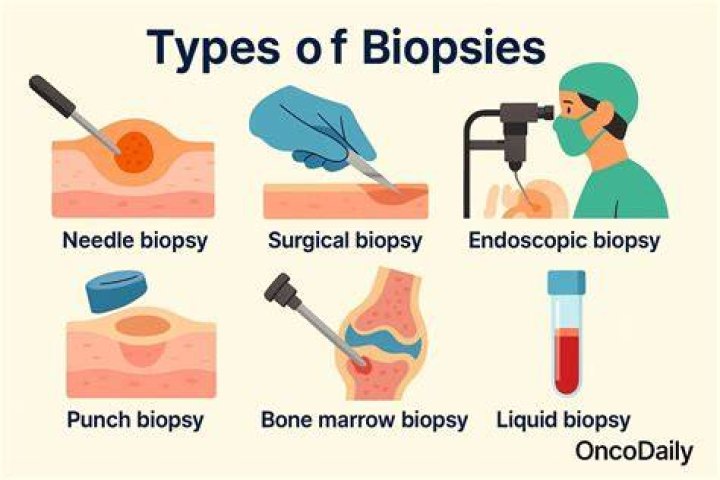 What does it mean if a biopsy is benign?