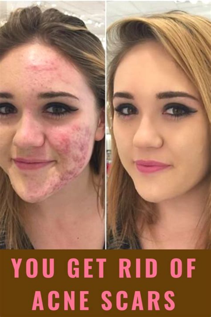 What gets rid of scar redness?