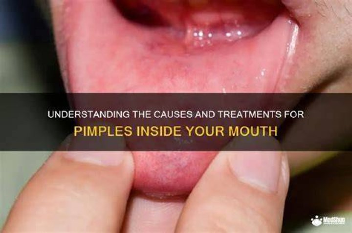What is a pimple inside your mouth called?