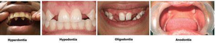 What is hypodontia vs anodontia?