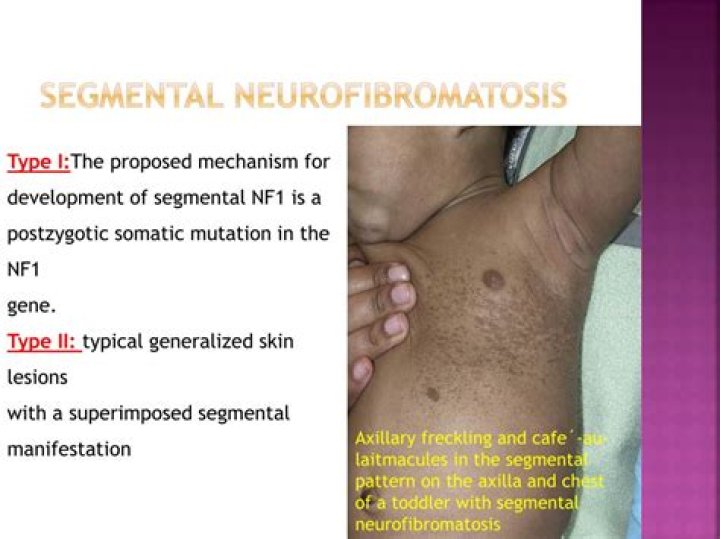What is segmental NF1?