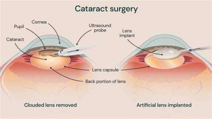 What is the most successful cataract surgery?