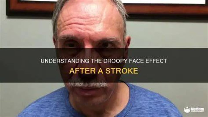 What side of your face droops after a stroke?