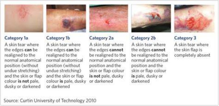 What stage is a skin tear?