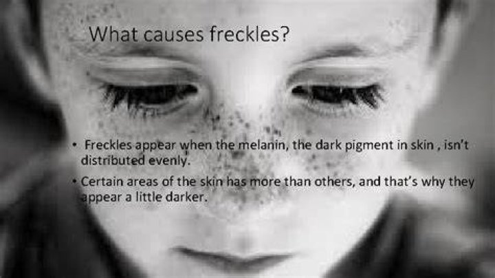 When do freckles appear in NF1?