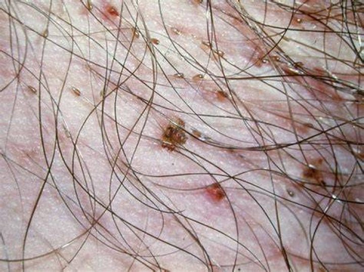 Why do I have a bald spot on my pubic area?