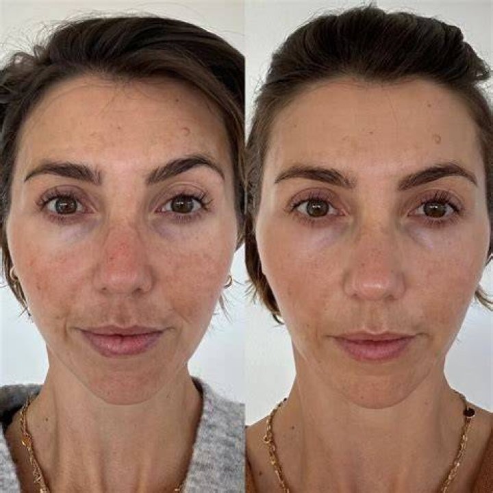 Will microneedling help with hyperpigmentation?